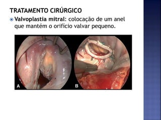 TRATAMENTO CIRÚRGICO
 Valvoplastia mitral: colocação de um anel
que mantém o orifício valvar pequeno.
 