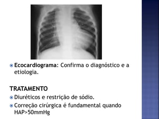  Ecocardiograma: Confirma o diagnóstico e a
etiologia.
TRATAMENTO
 Diuréticos e restrição de sódio.
 Correção cirúrgica é fundamental quando
HAP>50mmHg
 