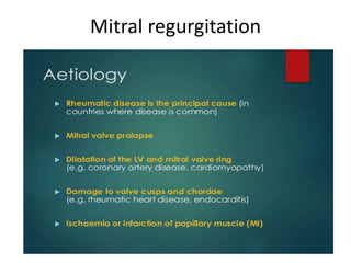 Mitral regurgitation
 