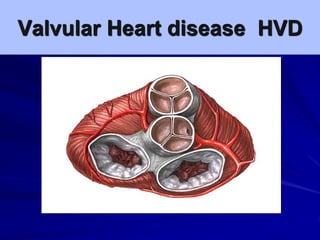 Valvular Heart disease HVD
 