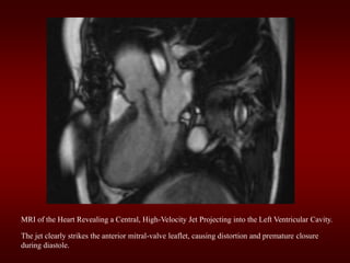 MRI of the Heart Revealing a Central, High-Velocity Jet Projecting into the Left Ventricular Cavity.
The jet clearly strikes the anterior mitral-valve leaflet, causing distortion and premature closure
during diastole.
 