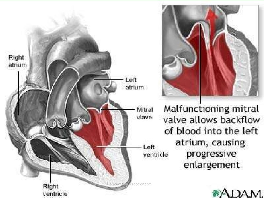 Valvular heart disease