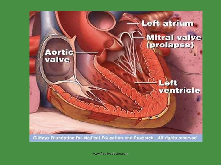 Valvular heart disease