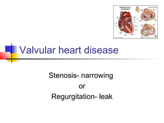 Valvular heart disease
Stenosis- narrowing
or
Regurgitation- leak
 