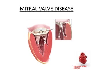 VALVULAR HEART
DISEASE
MITRAL VALVE DISEASE
 