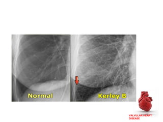 VALVULAR HEART
DISEASE
 
