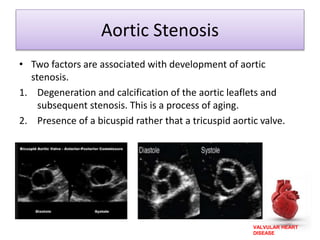 VALVULAR HEART
DISEASE
Aortic Stenosis
• Two factors are associated with development of aortic
stenosis.
1. Degeneration and calcification of the aortic leaflets and
subsequent stenosis. This is a process of aging.
2. Presence of a bicuspid rather that a tricuspid aortic valve.
 