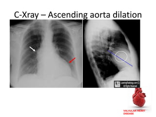VALVULAR HEART
DISEASE
C-Xray – Ascending aorta dilation
 