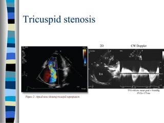 Valvular heart disease assessment of lesion severity