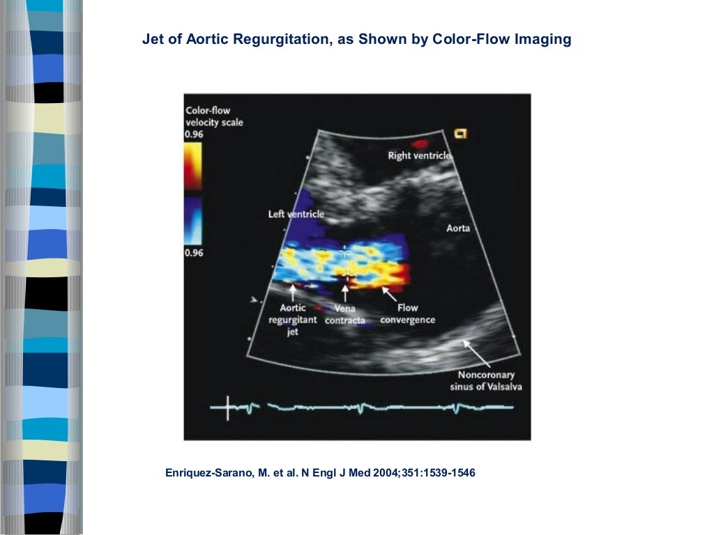 Valvular heart disease assessment of lesion severity
