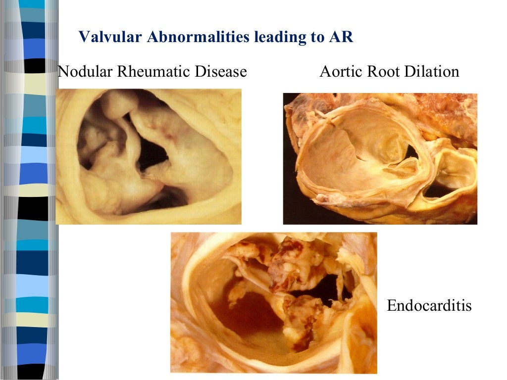 Valvular heart disease assessment of lesion severity