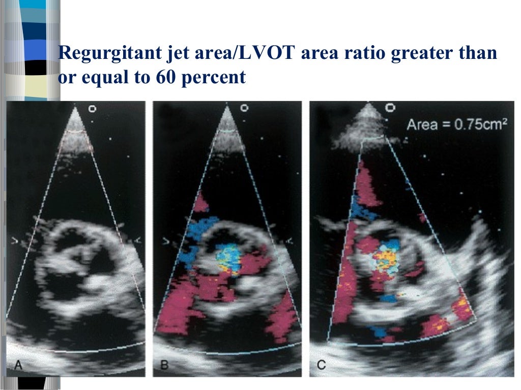 Valvular heart disease assessment of lesion severity