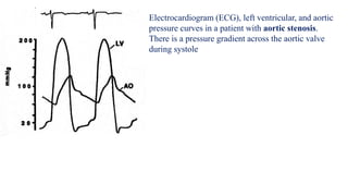 Electrocardiogram (ECG), left ventricular, and aortic
pressure curves in a patient with aortic stenosis.
There is a pressure gradient across the aortic valve
during systole
 