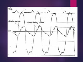 Slow Rising Pulse Sign Valvular_heart_disease_aortic_valve_disease.pdf