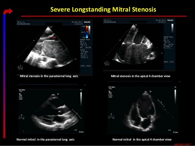 Valvular heart disease cardiology club 11 18 2015