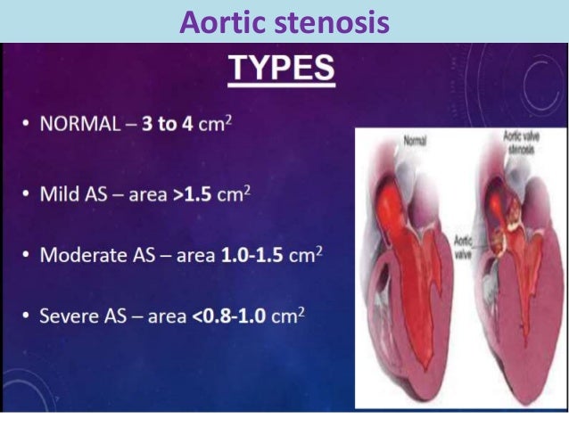 Valvular heart disease for post graduates