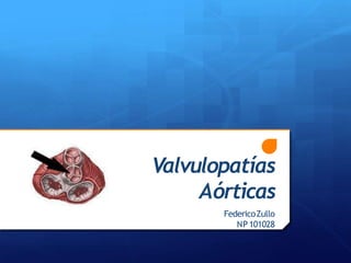 Valvulopatías
Aórticas
FedericoZullo
NP101028
 