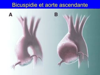Bicuspidie et aorte ascendante

 