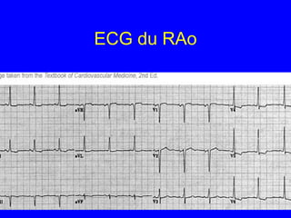 ECG du RAo

 