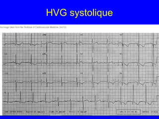 HVG systolique

 