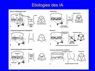 Etiologies des IA

 