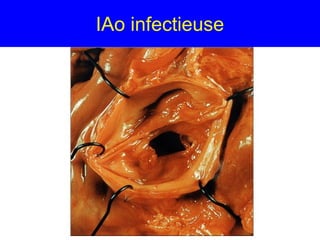 IAo infectieuse

 