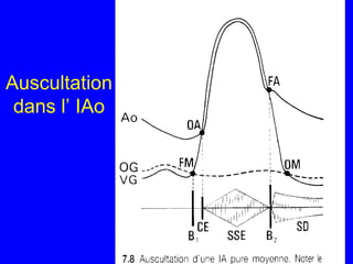 Auscultation
dans l’ IAo

 