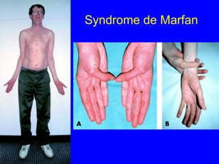 Syndrome de Marfan

 