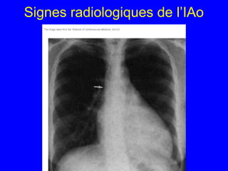Signes radiologiques de l’IAo

 