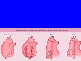 Valvulopathies aortiques