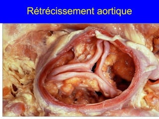 Rétrécissement aortique

 