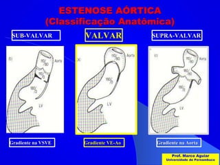 Valvar Valvulopatia Aortica ppt | PPTX