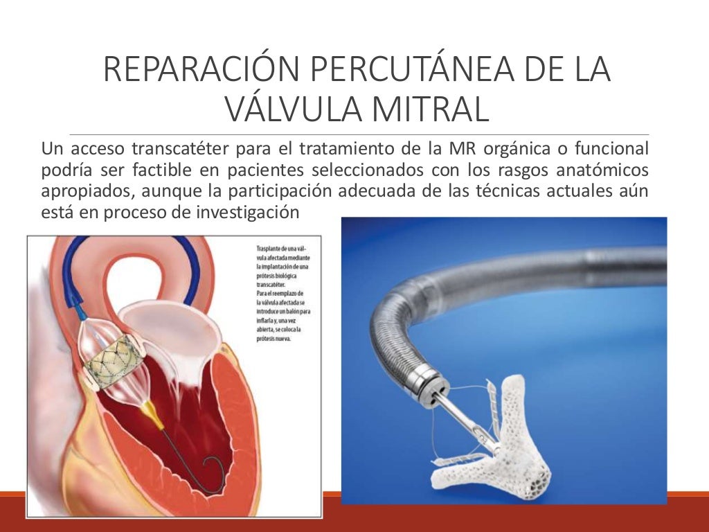 Valvulopatia mitral.