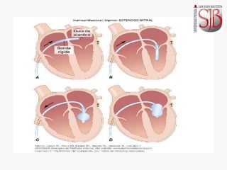 Comprehensive Overview of Mitral Valve Disease: Stenosis and ...