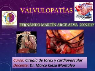 FERNANDO MARTÍN ARCE ALVA 20092177
Curso: Cirugía de tórax y cardiovascular
Docente: Dr. Marco Cieza Montalvo
 