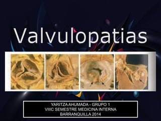 YARITZA AHUMADA - GRUPO 1
VIIIC SEMESTRE MEDICINA INTERNA
BARRANQUILLA 2014
 