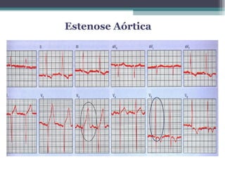 DIAGNÓSTICO- ELETROCARDIOGRAMA
 Sinais de HVE
 Aumento da amplitude dos complexos
QRS
 Sobrecarga atrial esquerda
 Bloqueio de ramo
 Alteração isquêmica da onda T
Estenose Aórtica
 