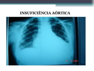 INSUFICIÊNCIA AÓRTICA
DIAGNÓSTICO – RADIOGRAFIA DE TÓRAX:
Área Cardíaca Aumentada: na IAo crônica
Pode haver congestão pulmonar
Alargamento da aorta ascendente pode sugerir
doença da raiz da aorta.
 