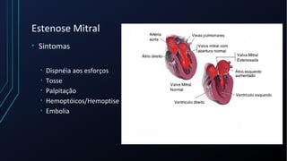 Estenose Mitral
• Sintomas
• Dispnéia aos esforços
• Tosse
• Palpitação
• Hemoptóicos/Hemoptise
• Embolia
 