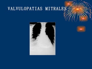 VALVULOPATIAS MITRALES 