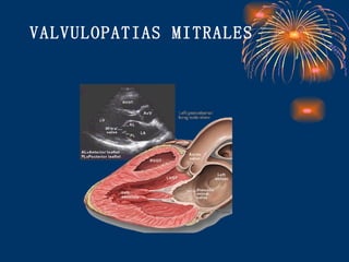 VALVULOPATIAS MITRALES 