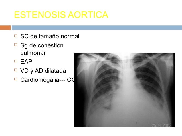 El dolor en el hombro por el cuello