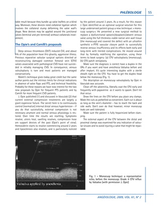 PHLÉBOLOGIE              55

table result because they bundle up valve leaflets on a blind     by the patient around 3 years. As a result, for this reason
way. Moreover, these devices need collateral ligation which       J. Opie identified as an optional surgical solution for this
involves the collateral stump deforming the valve wall’s          large underserved patient group a new technique: « mono-
shape. New devices may be applied around the junctional           cusp surgery ». He presented a new surgical method to
valves (terminal and pre-terminal) without collaterals invol-     replace a dysfunctional aplastic/dysplastic/absent venous
vement.                                                           valve using the full thickness viable native vein wall tissue
                                                                  (the monocusp) and covered the defect with an ultrathin
The Opie’s and Camilli’s proposals                                synthetic e-PTFE vascular closure patch to successfully
                                                                  reverse venous insufficiency and its effects both early and
   Deep venous thrombosis (DVT) induced CVI, and about            long-term with limited complications. He moved around
5% of the population have this ghastly, aggressive illness.       that by formally redefining the operation, using these
Previous reparative valvular surgical options directed at         terms to book surgery: (a) CFV valvuloplasty (monocusp);
reconstructing damaged common femoral vein (CFV)                  (b) CFV patch venoplasty.
valves associated with pathological CVD have not succee-              Make sure the diagnosis is correct have a duplex in the
ded in reliably managing CVD. In consequence, venous              ORs if you want and have anesthesia Valsalva before and
valvuloplasty is rare and most patients are managed               after implant. It’s quite interesting duplex with a sterile
conservatively.                                                   sheath right on the CFV. You have to get the duplex head
   Maleti’s techinque gives today great credit but the same       below the monocusp (Fig. 1).
author points out the intrinsic limits for clinical indications       The description on monoscusp valvuloplasty by Opie in
in absence of valve flaps and PTS, and technical feasibility.     Vasculab was accurate.
Probably for these reasons we have now interest for the two           Clean off the adventitia, liberally coat the CFV early and
new proposals by Opie for frequent PTS patients and by            frequently with papaverine as it wants to spasm. Don’t let
Camilli for more frequent CVD patients.                           that occur.
   J. Opie published (1) and discussed in Vasculab (2) that           Draw the lines on the CFV before you place any clamps.
current external compression treatments are largely a             Make the cuts as potbellied as convenient. Each cut is about
giant expensive failure. The secret here is to continuously       as long as the vein’s diameter - has to reach the back and
control (normalize) internal distal venous hypertension - if      side walls. Don’t over do that however, minor monocusp
you do that successfully, external compression is not             leaks are well tolerated.
necessary anymore and normal venous physiology is res-                Make sure the patient is fully heparinized before clam-
tored. Over time the results are startling. Symptoms              ping.
resolve, ulcers heal, swelling resolves, compression hose             The external aspect of the CFV between the distal and
are support devices of the past (Opie’s point of view).           proximal clamps was examined for any indication of valvu-
Hemosiderin starts to resolve commencing around 2 years           lar sinuses and to avoid injuring a valve that might be repai-
and liposclerosis also resolves, and is particularly noticed      rable.




                                                                          Fig. 1 - Monocusp technique: a representative
                                                                          echo, before the monocusp. Grade 4 CFV reflux
                                                                          by Valsalva (with permission J. Opie)




                                                                                   ANGÉIOLOGIE, 2009, VOL. 61, N° 2
 