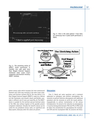 PHLÉBOLOGIE              57




                                                                            Fig. 4 - Here is the same patient 1 hour later.
                                                                            I.E. monocusp now in place (with permission J.
                                                                            Opie).




Fig. 5 - The stretching action of
OSESTM (with permission S.
Camilli): vein wall axial view;
Oval Shaped External Support;
slackened valve cusps; cusp’s
coaptation and function recovery;
OSESTM stitched.




petent venous valve which increases the inter-commissural         Discussion
diameter and, inthis way, resulting in the valve cusp’s coap-
tation and function recovery (Fig 5). The new device is an           First, C. Recek put some questions and a comment
Oval Shaped External Support (OSESTM), made by a Nitinol          addressed to colleagues who perform valvuloplasty: the
net-like framework, very smooth, elastic and flexible, avai-      necessity to perform selective valvuloplasty with additional
lable in different size (3 sizes just now) (Fig. 6). The OSESTM   procedure and the necessity to verify the results plethys-
device is suitable for the terminal and pre-terminal valves       mographically to achieve normalization of the venous
of the GSV, also without ligation of the possible present         hemodynamics. As concerns the indication to valvuloplasty,
competent collaterals. Virtually the Camilli’s device can be      it must be distinguished between PVV and PTS. In PVV could
useful for any peripheral venous valve, on superficial and        be taken into consideration for valvuloplasty the incompe-
deep system, obviously when the valves are present.               tent CFV and the incompetent GSV. As concerns the femo-


                                                                                  ANGÉIOLOGIE, 2009, VOL. 61, N° 2
 