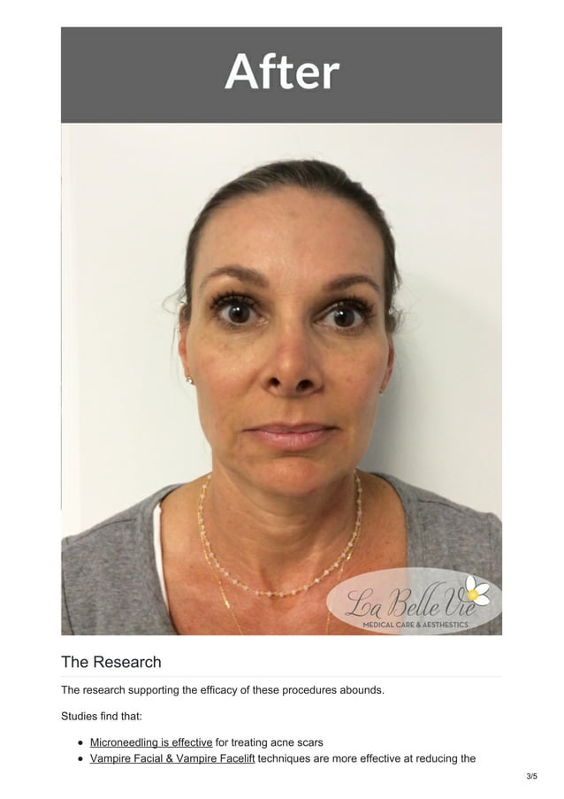Vampire Facelift And Vampire Facial In Draper Utah PDF vampire-facelift-and-vampire-facial-in-draper-utah-pdf