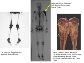 Bone Scan: Ewing Sarcoma of
                                 Left Humerus demonstrates
                                 Intense Uptake




Fig: bone scan shows increased     Gross Pathology: Ewing Sarcoma of
activity in the distal femur.      Metadiaphysis of Proximal Humerus. (Top
                                   arrow) Permeative Marrow Lesion.
                                   (Bottom arrow) Surrounding Soft Tissue
                                   Mass
 