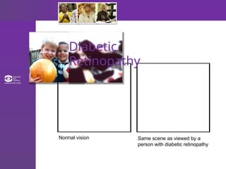 Diabetic
Retinopathy
Normal vision Same scene as viewed by a
person with diabetic retinopathy
 