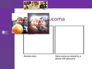 Glaucoma
Normal vision Same scene as viewed by a
person with glaucoma
 