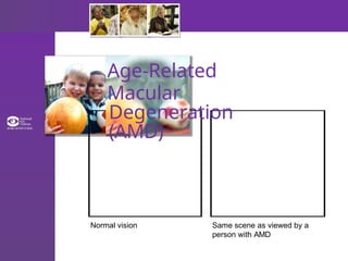 Age-Related
Macular
Degeneration
(AMD)
Normal vision Same scene as viewed by a
person with AMD
 