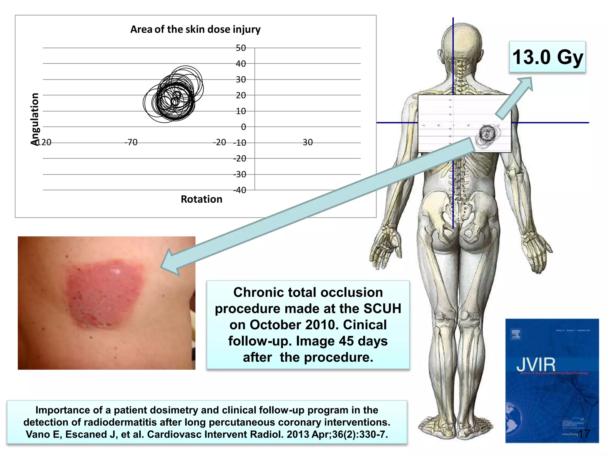 13.0 Gy
-40
-30
-20
-10
0
10
20
30
40
50
-120 -70 -20 30
Angulation
Rotation
Area of the skin dose injury
Chronic total occlusion
procedure made at the SCUH
on October 2010. Cinical
follow-up. Image 45 days
after the procedure.
Importance of a patient dosimetry and clinical follow-up program in the
detection of radiodermatitis after long percutaneous coronary interventions.
Vano E, Escaned J, et al. Cardiovasc Intervent Radiol. 2013 Apr;36(2):330-7. 17
 